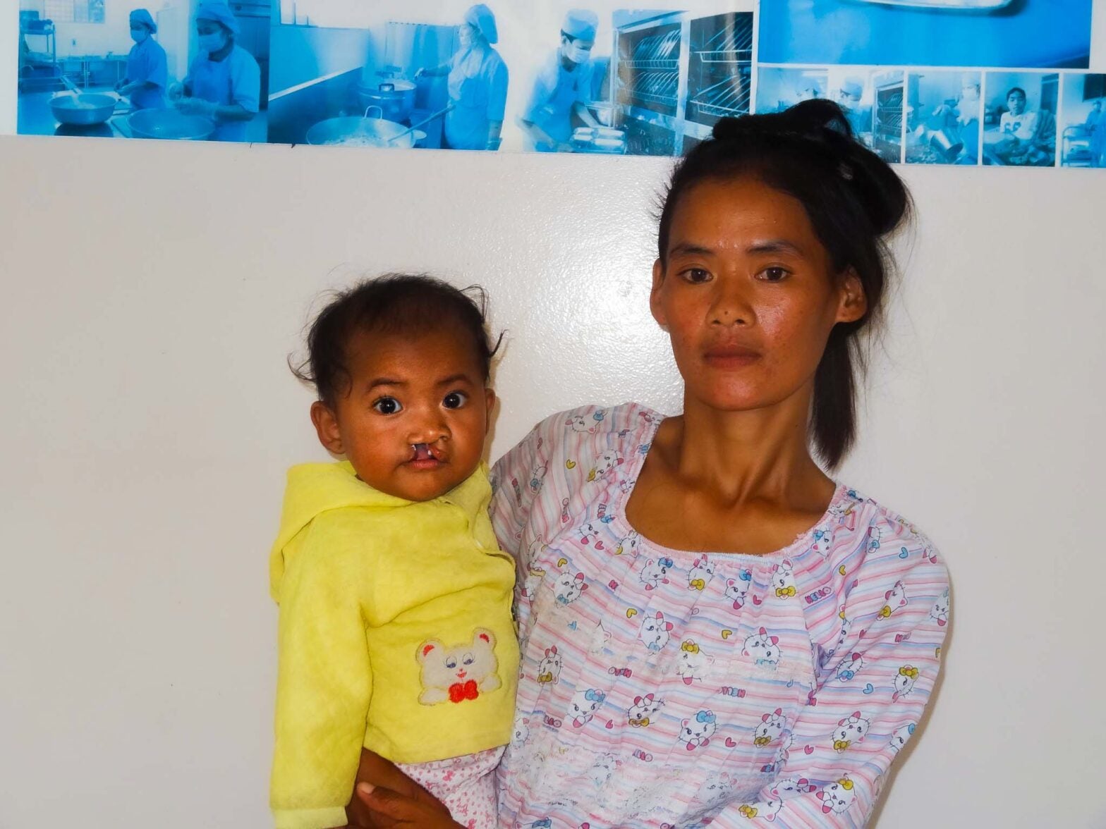 cleft lips surgery in cambodia for child