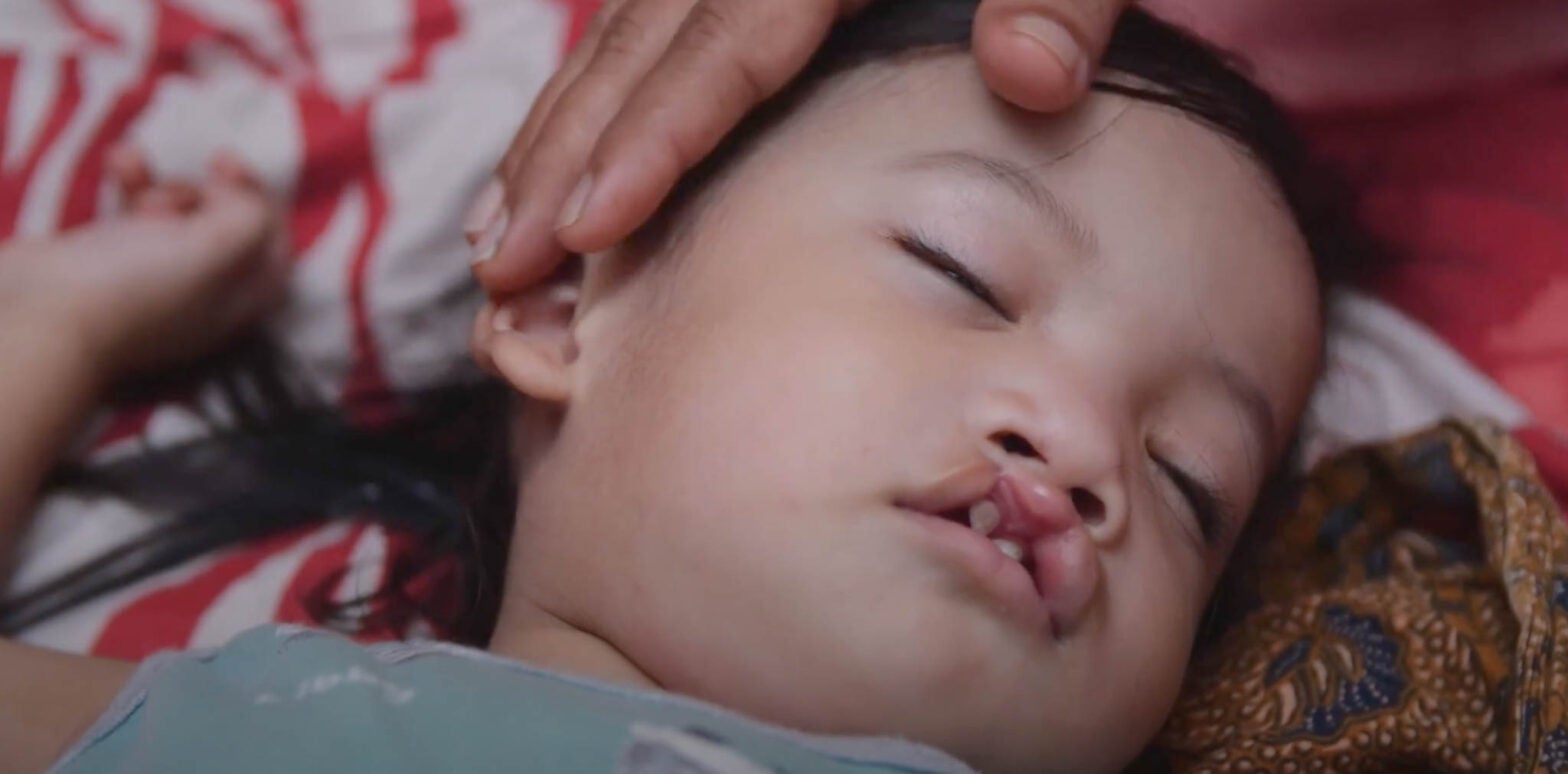 healing journey from cleft in indonesia