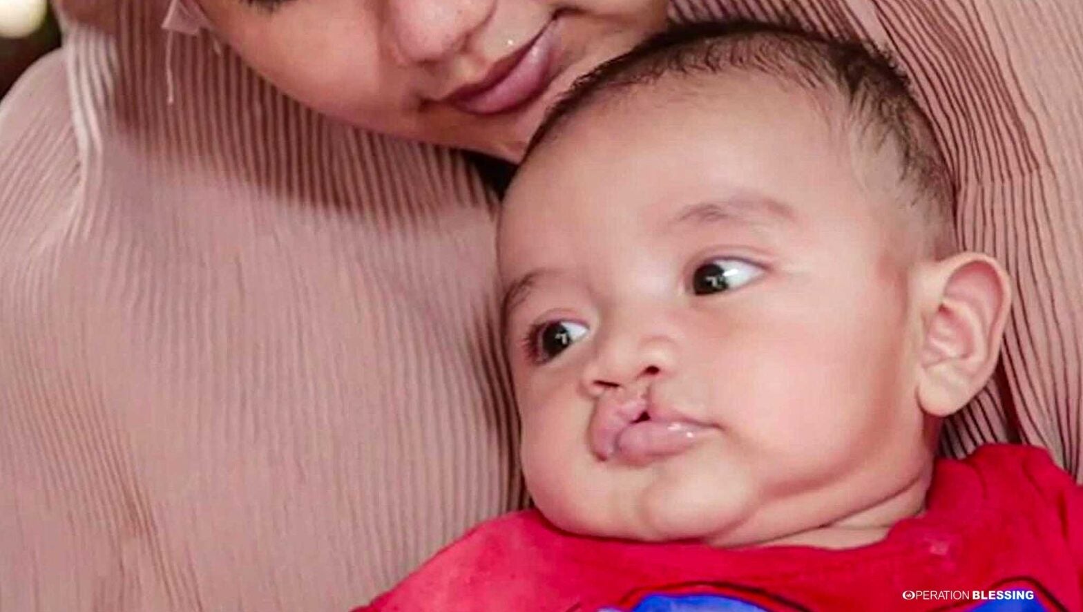 indonesia cleft lip child surgery