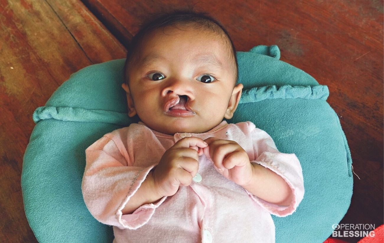 born with severe cleft lip