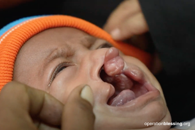 Severe cleft in Cambodia