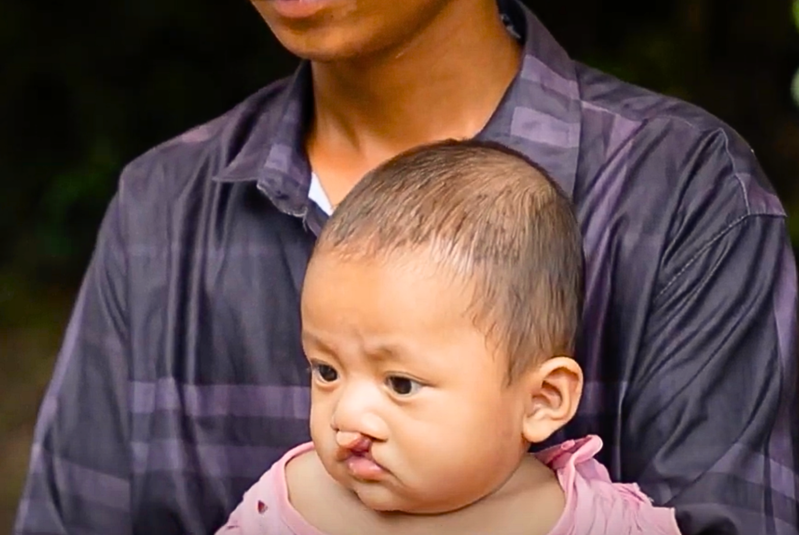 born with cleft lip