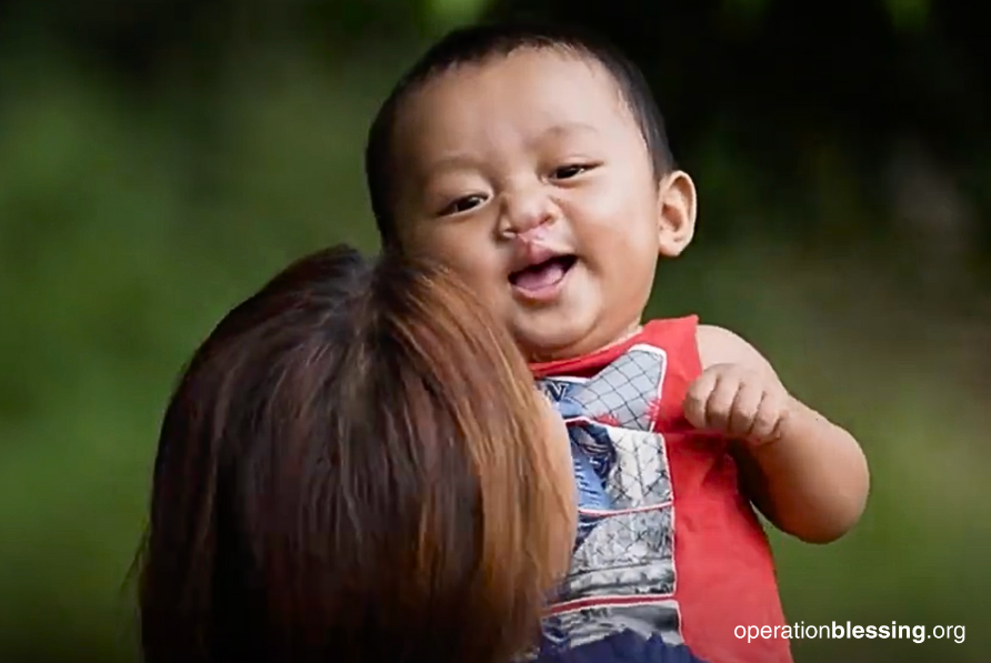 healed from cleft lip