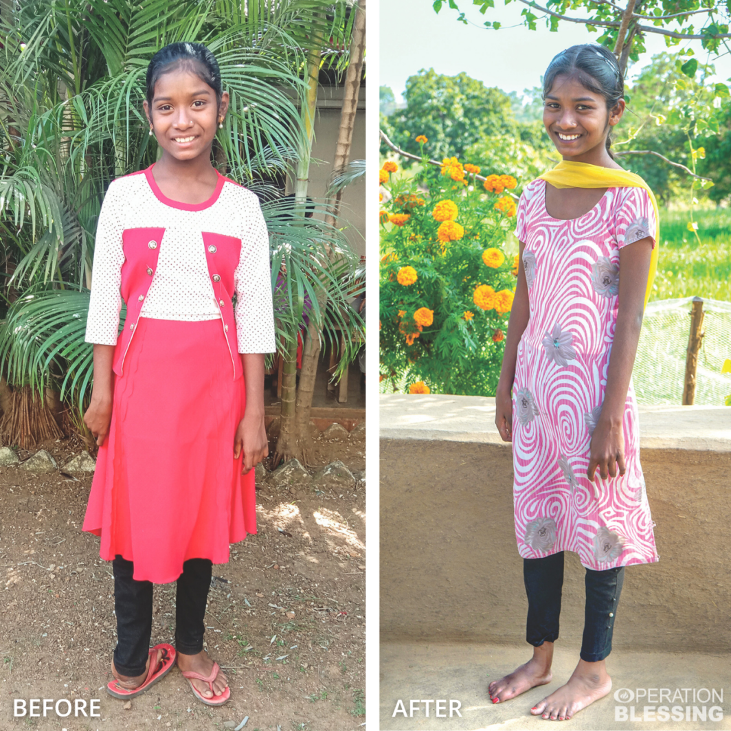 overcoming clubfoot in india