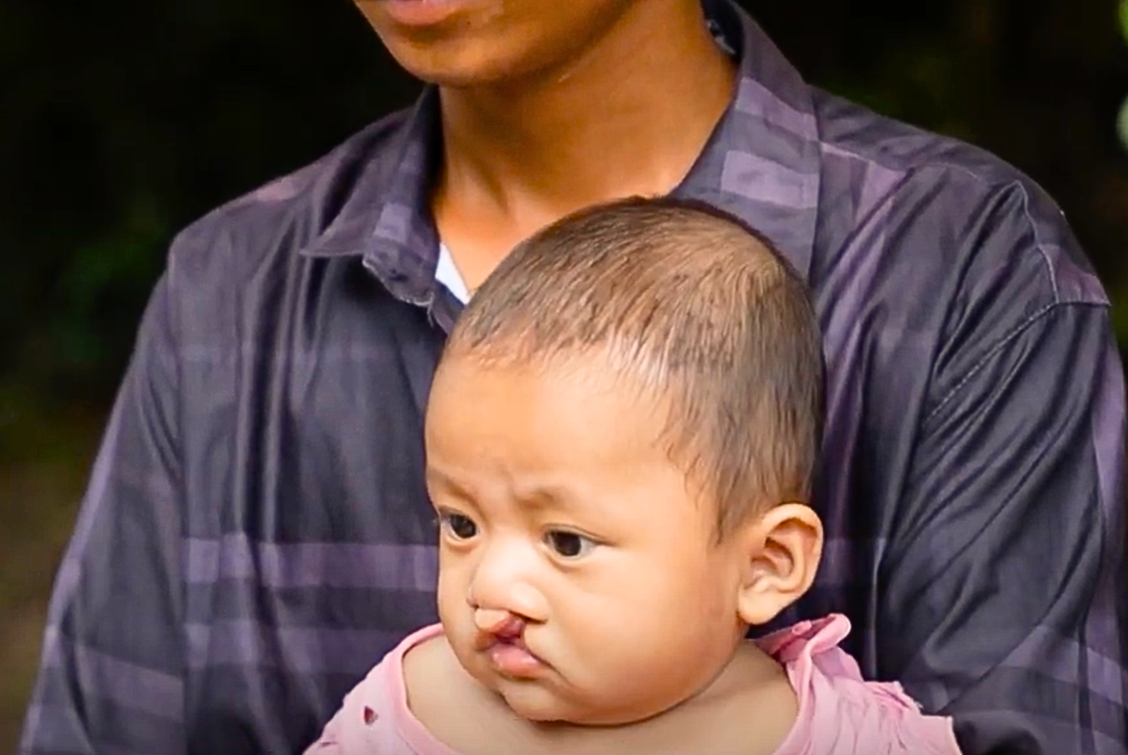 born-with-cleft-lip-in-cambodia-1