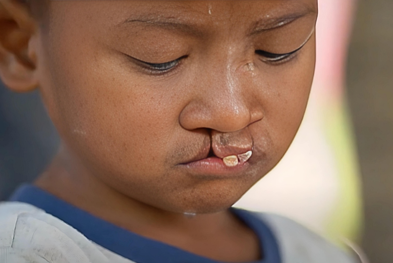 Overcoming Bullying From Cleft Lip