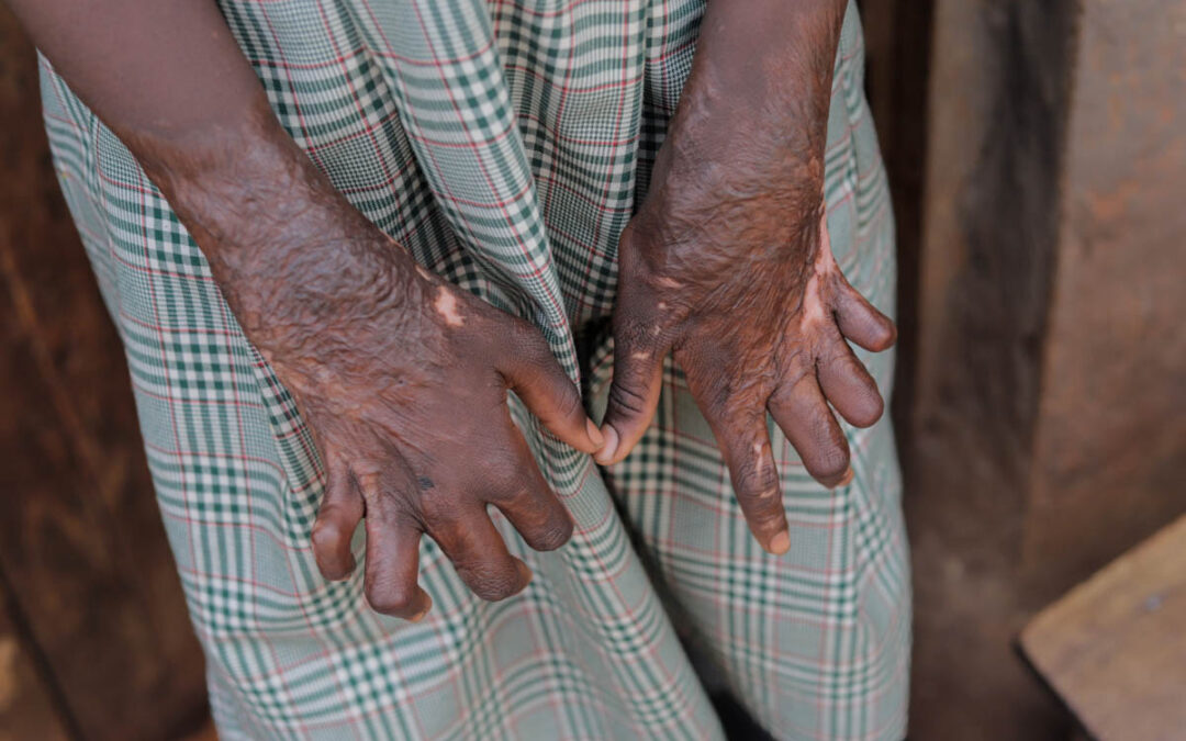 Hope After the Flames