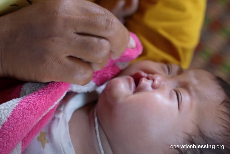 child with cleft lip