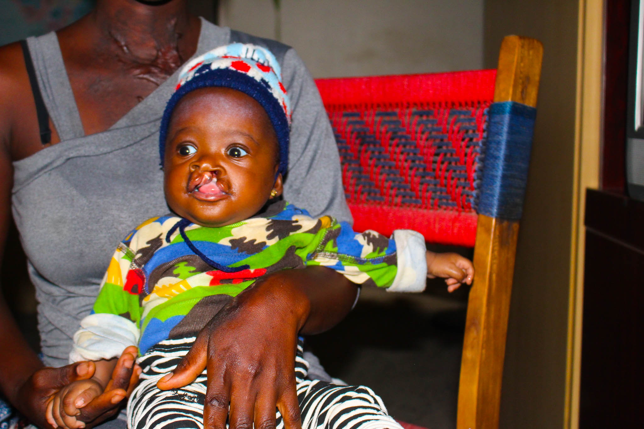 Cleft Lip Surgery In Nigeria