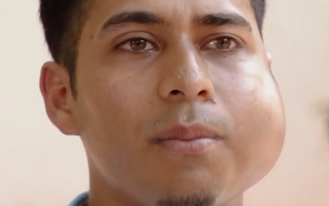 A New Life for Tumor Patient in Honduras