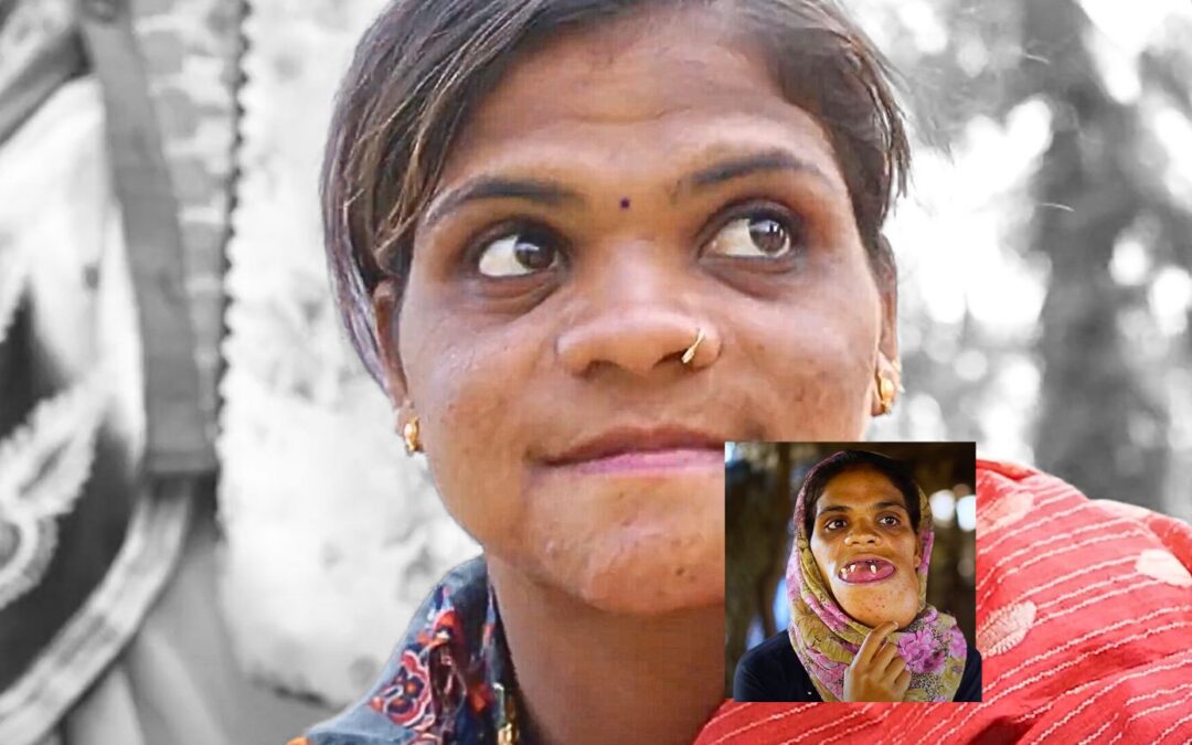 Overcoming a Facial Deformity: A Journey from Shame to Dignity