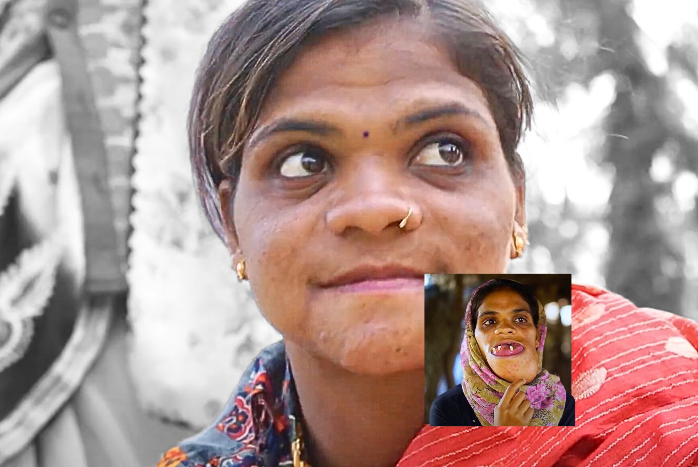 facial-deformity-2 facial deformity