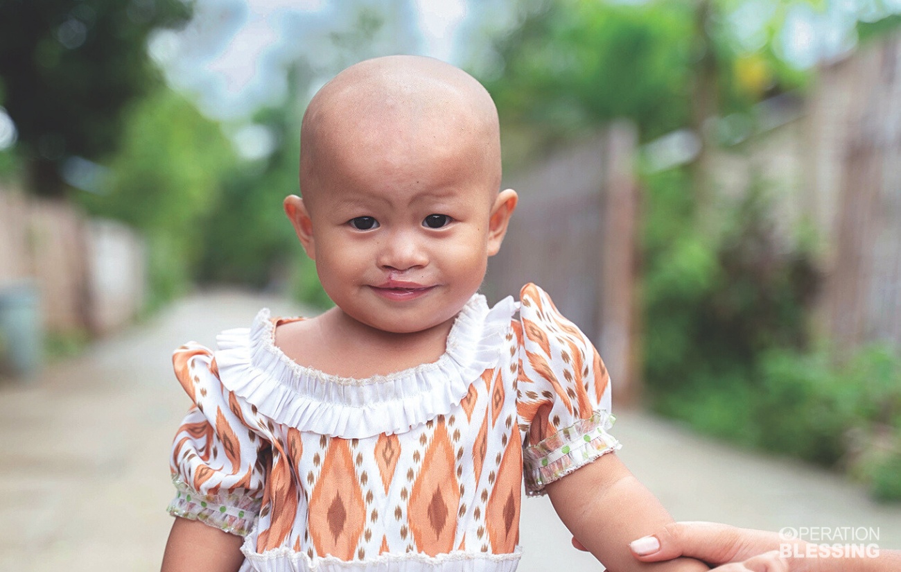 surgery for Thoon in Myanmar