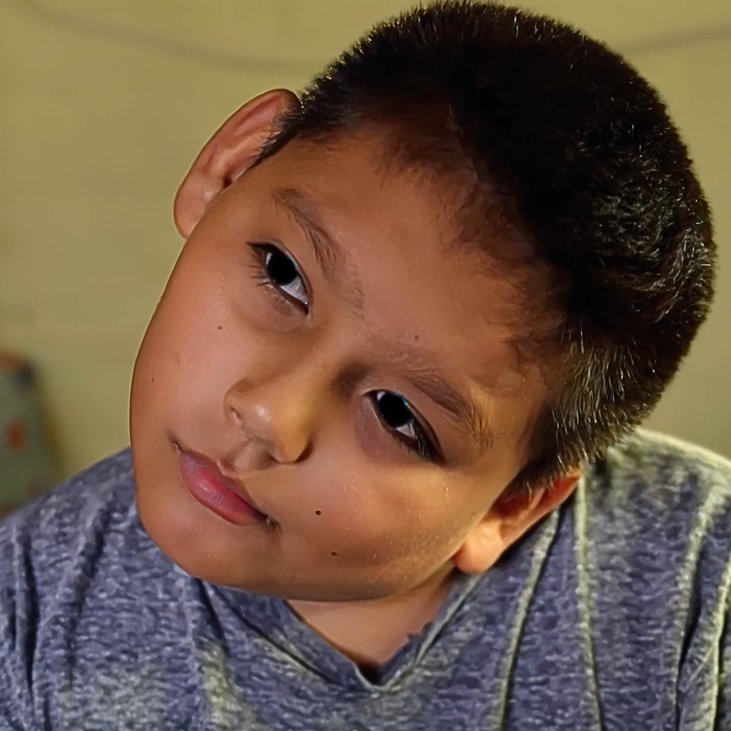 life changing Torticollis surgery life changing Torticollis surgery