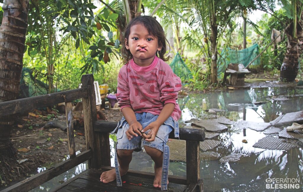 need for cleft lip surgery in Cambodia