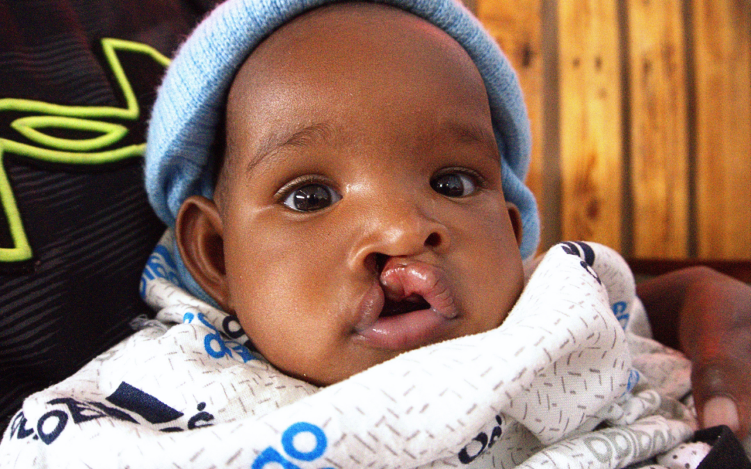 Life-Changing Cleft Surgery Blesses a Little Life
